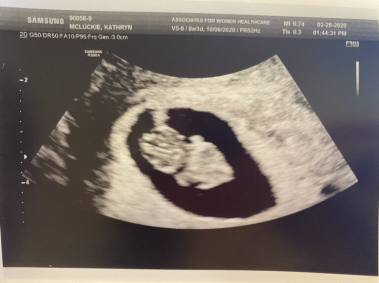 First Trimester Scare – Subchorionic Hemorrhage/Bleed